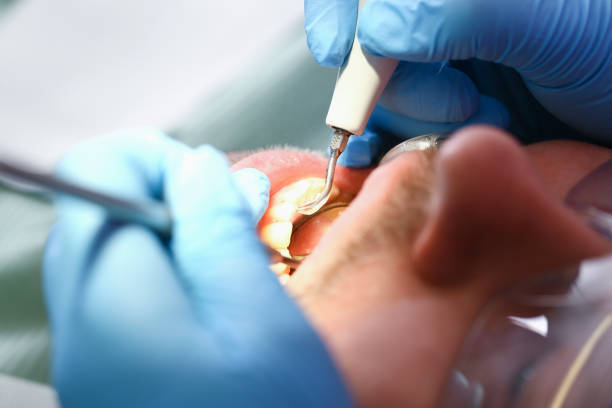 Best Urgent Care for Lost Fillings or Crowns in Reading, PA